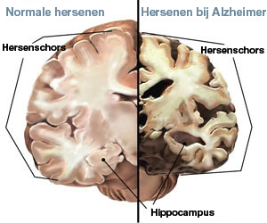 Gezonde Hersenen En Hersenen Met De Ziekte Van Alzheimer