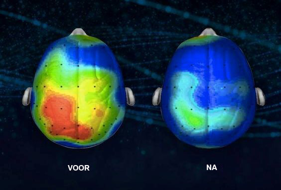 Voor En Na Afbeelding Van Het Effect Dat Meditatie Heeft Op De Hersenen Want Meditatie Kan De Geest Ontspannen