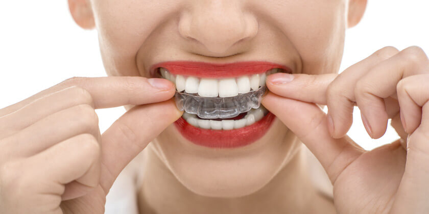 Vrouw die een bitje in doet omdat ze last heeft van bruxisme