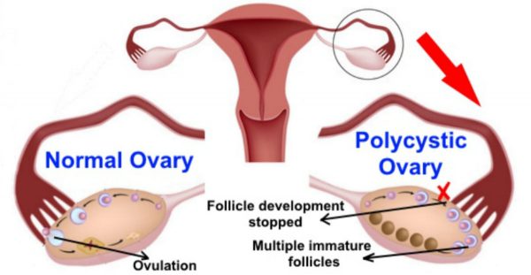Polycysteus-ovariumsyndroom