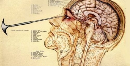De toepassing van de lobotomie