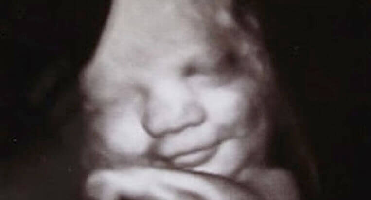 Echo van een glimlachende foetus