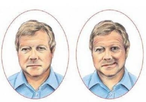 De symptomen van een beroerte