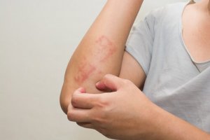Zes tips om atopische dermatitis te behandelen