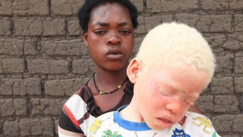 Kind met albinisme