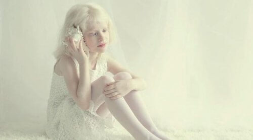 Meisje dat lijdt aan albinisme