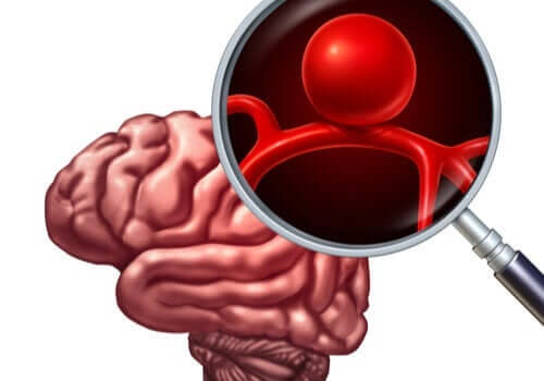 Een uitvergroting van een hersenaneurysma