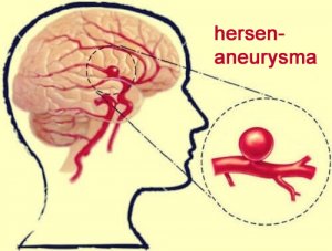 Wat is een hersenaneurysma precies?