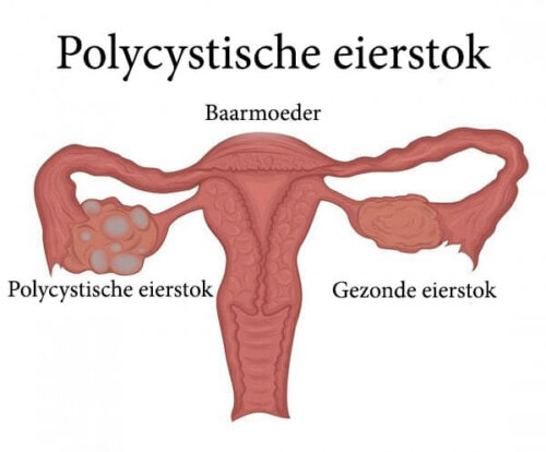 Leer alles over het polycysteus-ovariumsyndroom