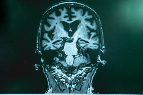 Hersenen van iemand met ziekte van Alzheimer