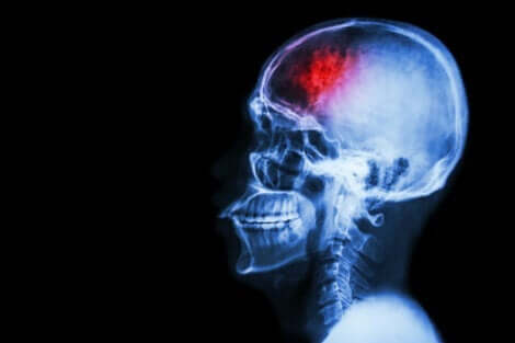 Wat gebeurt er in de hersenen na een beroerte