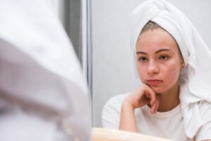 De psychologische impact van acne in de adolescentie