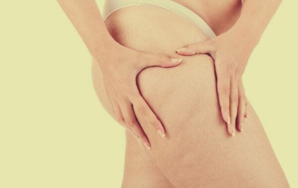 Lipoedeem: meer dan obesitas