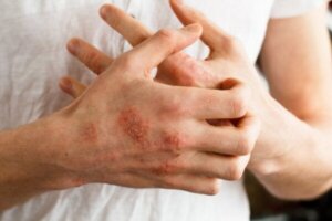 Neurodermitis: oorzaken, symptomen en behandeling